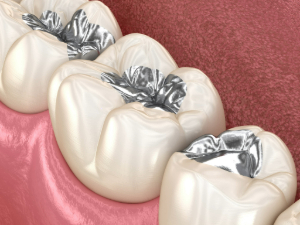 Illustrations of dental fillings made out of metal